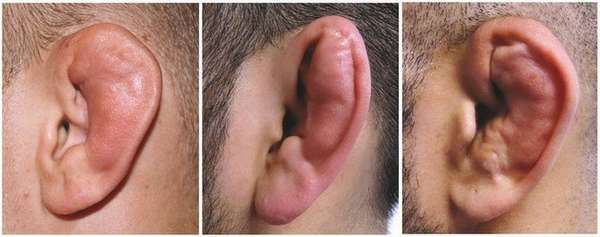 Классификация переломов уха